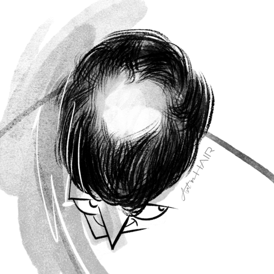 férfi hajról grafika hajbeültetés előtt